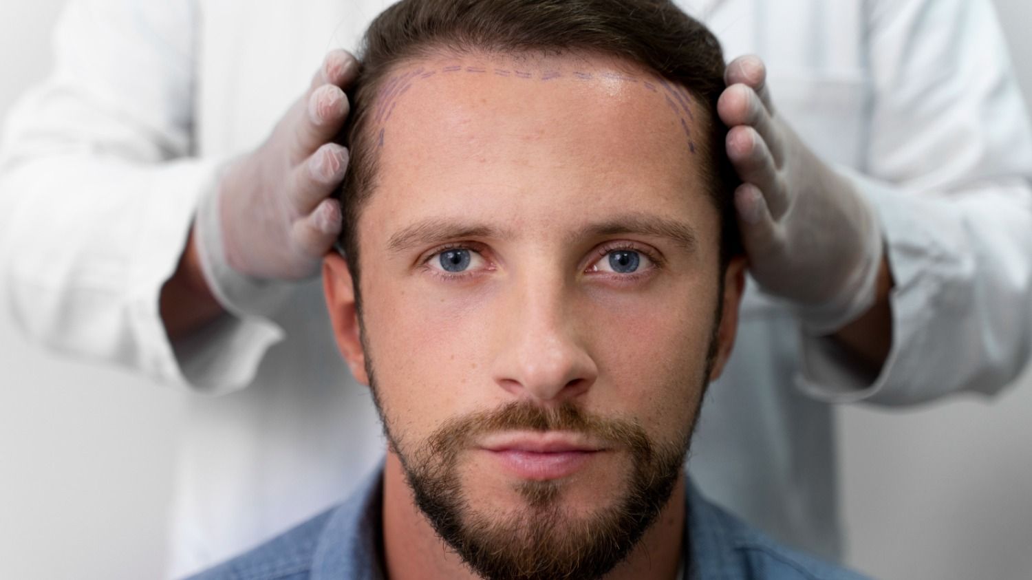 What to do after a hair transplant? Recovery and maintenance guide