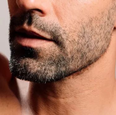 Beard Transplant