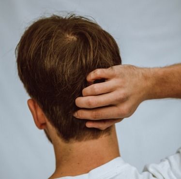 Hair loss in men