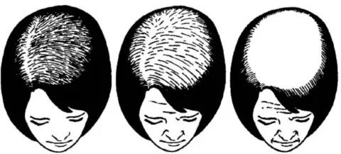 HOW ARE THE STAGES OF BALDNESS IN WOMEN EVALUATED?
