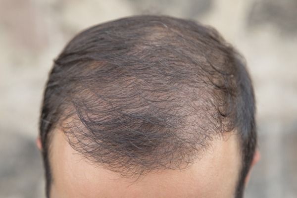 heredite_et_calvitie_quelles_chances_de_perdre_ses_cheveux_si_vos_parents_sont_touches_