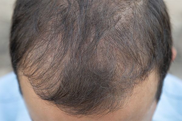 greffe_de_cheveux_ratee_comment_la_reconnaitre_et_que_faire_