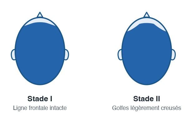 echelle_de_norwood_a_quel_stade_de_calvitie_envisager_une_greffe_de_cheveux