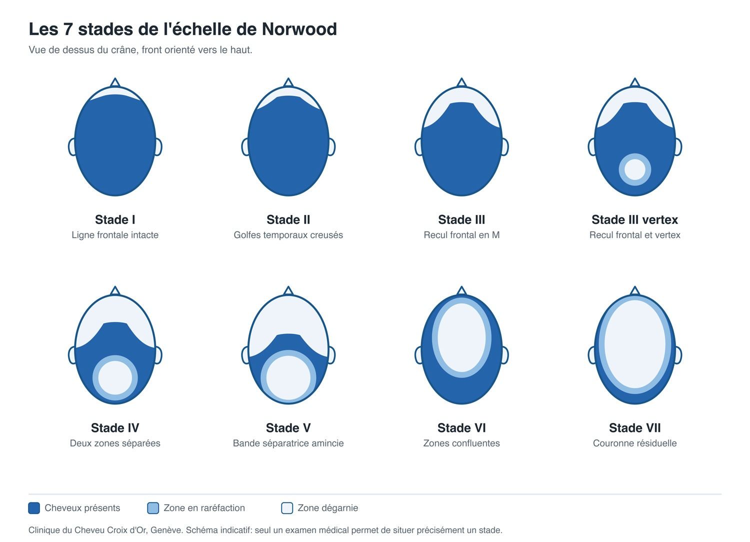 echelle_de_norwood_a_quel_stade_de_calvitie_envisager_une_greffe_de_cheveux