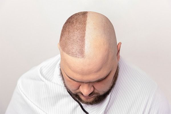 tricopigmentation