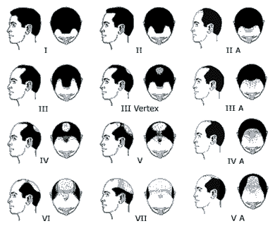 EVALUATION OF STAGES OF BALDNESS IN MEN